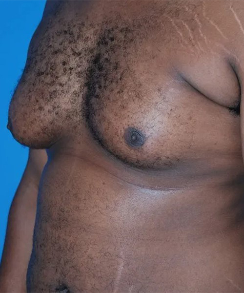 before gynecomastia angle view case 4932