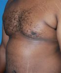 after gynecomastia angle view case 4932