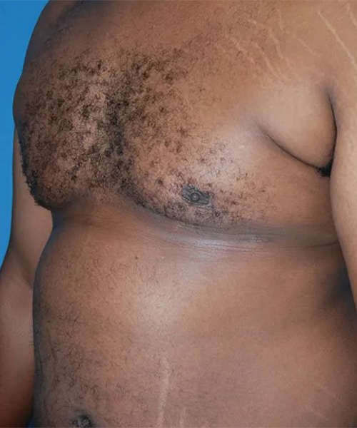 after gynecomastia angle view case 4932
