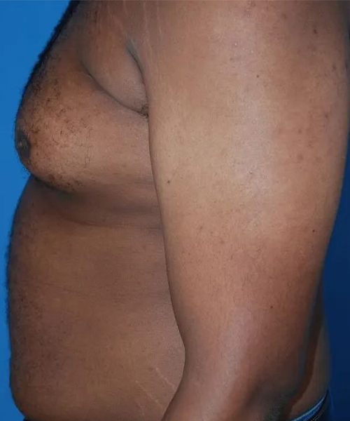 before gynecomastia side view case 4932