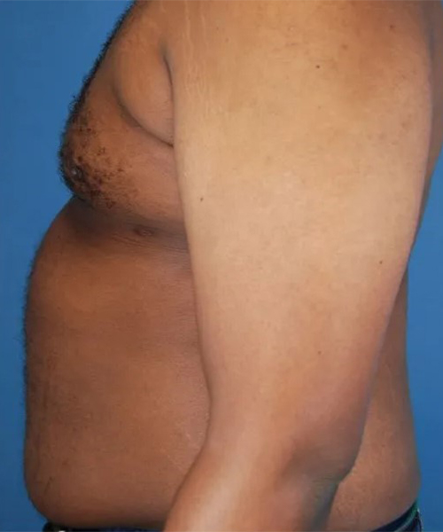 after gynecomastia side view case 4932