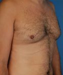 before gynecomastia angle view case 4939