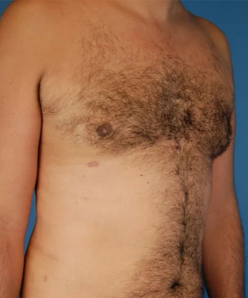 after gynecomastia angle view case 4939