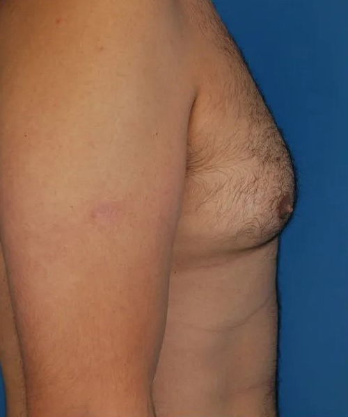 before gynecomastia left view case 4939