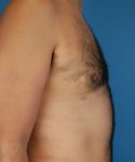 after gynecomastia side view case 4939