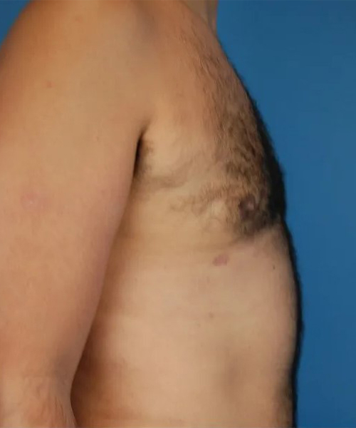 after gynecomastia side view case 4939