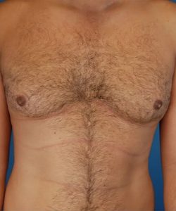 before gynecomastia front view case 4939