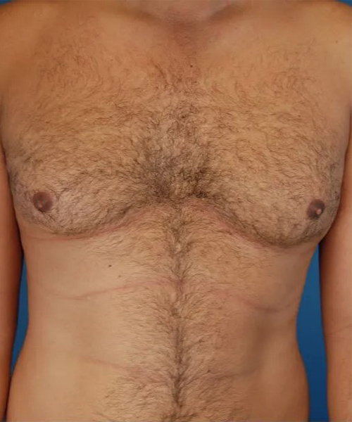 before gynecomastia front view case 4939