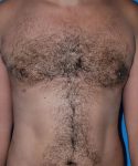 after gynecomastia front view case 4939