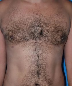 after gynecomastia front view case 4939