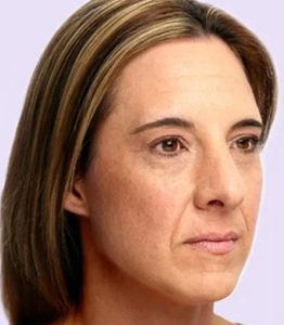 before fillers female patient angle view case 4946