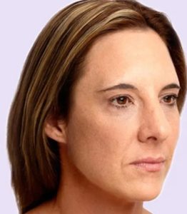 after fillers female patient angle view case 4946