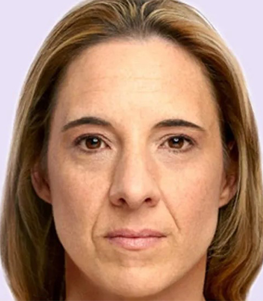 before fillers female patient front view case 4946