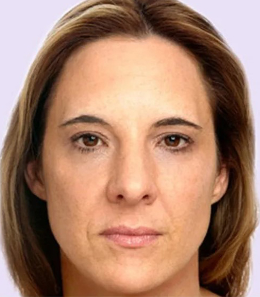 after fillers female patient front view case 4946