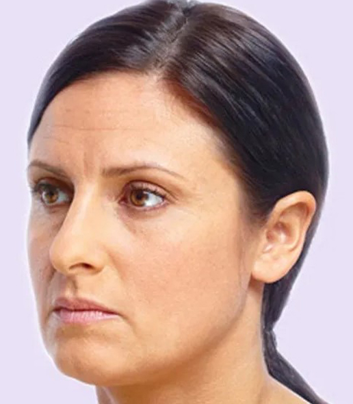 before fillers female patient left angle view case 4951
