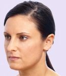 after fillers female patient left angle view case 4951