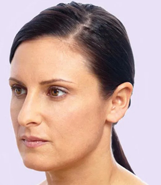 after fillers female patient left angle view case 4951