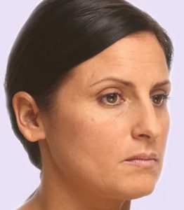 before fillers female patient angle view case 4951