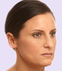 after fillers female patient angle view case 4951