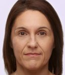 before fillers female patient angle view case 4956