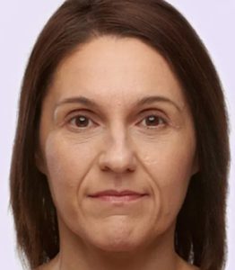 before fillers female patient angle view case 4956