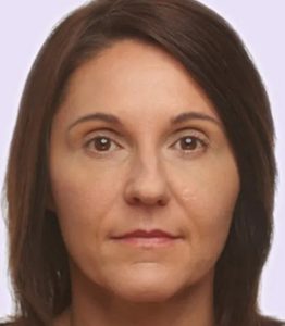 after fillers female patient front view case 4956