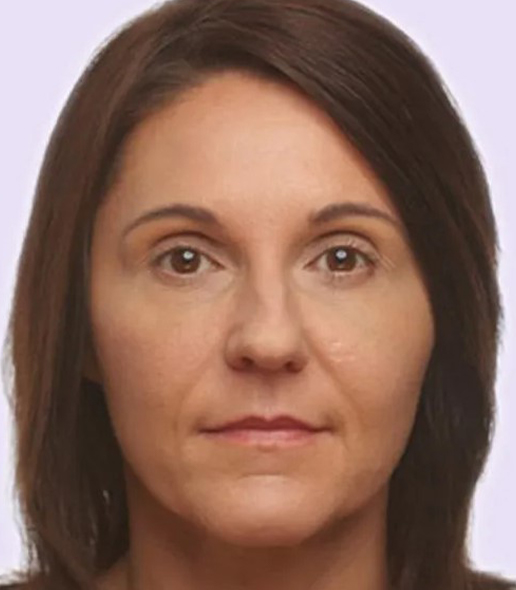 after fillers female patient front view case 4956