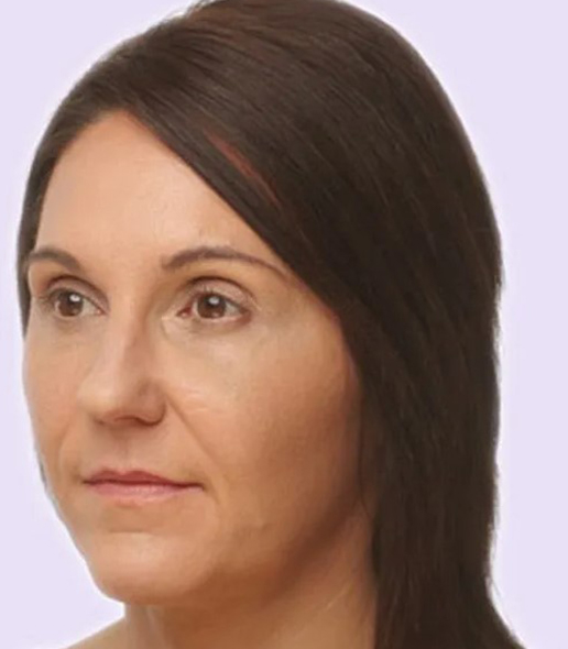 after fillers female patient angle view case 4956