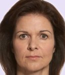 after fillers female patient front view case 4966
