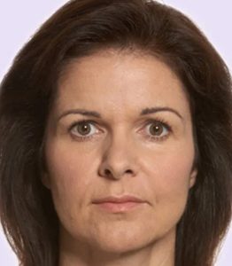 after fillers female patient front view case 4966