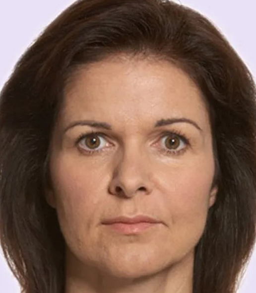 after fillers female patient front view case 4966
