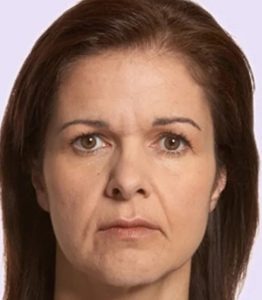 before fillers female patient front view case 4966