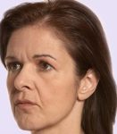 before fillers female patient angle view case 4966