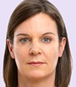 after fillers female patient front view case 4966