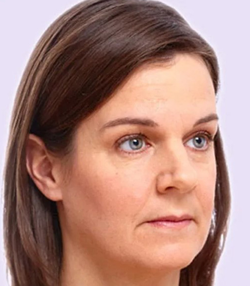 before fillers female patient angle view case 4966