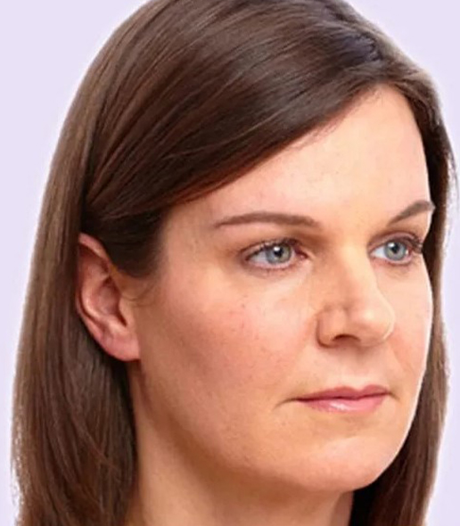 after fillers female patient angle view case 4966