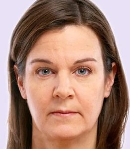 before fillers female patient front view case 4966