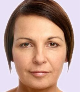 after fillers female patient front view case 4971