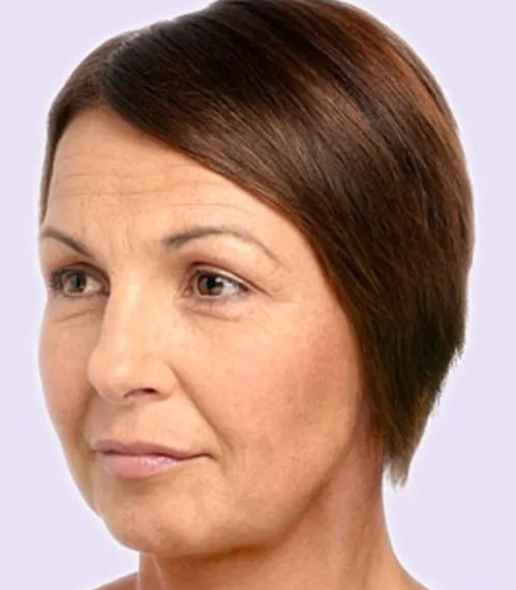 before fillers female patient angle view case 4971
