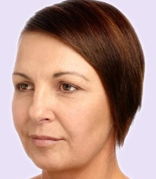after fillers female patient angle view case 4971