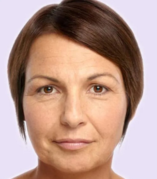before fillers female patient front view case 4971