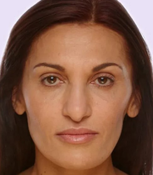 after fillers female patient front view case 4986