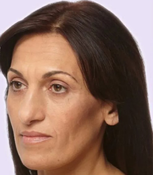 before fillers female patient angle view case 4976