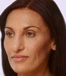 after fillers female patient angle view case 4976