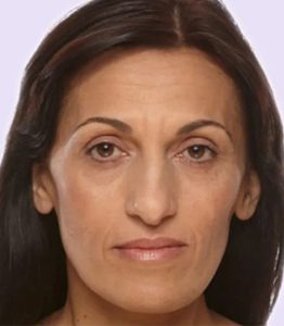 before fillers female patient front view case 4976