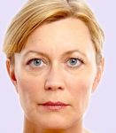 after fillers female patient angle view case 4981