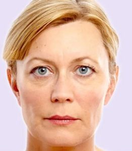 after fillers female patient angle view case 4981