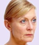 before fillers female patient angle view case 4981