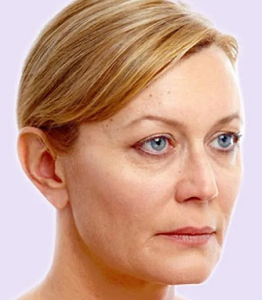 after fillers female patient angle view case 4981