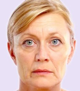 before fillers female patient front view case 4981